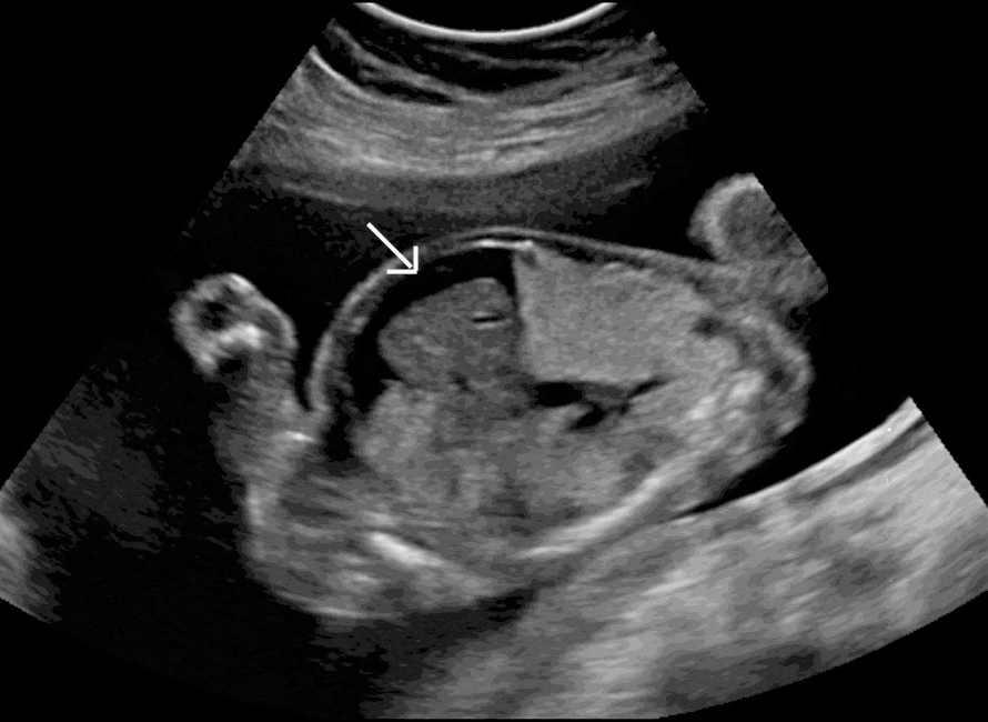 Photo of Hydrops ultrasound